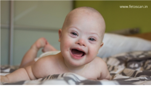 Read more about the article Detecting Down Syndrome before Birth: By a Fetal Care Expert