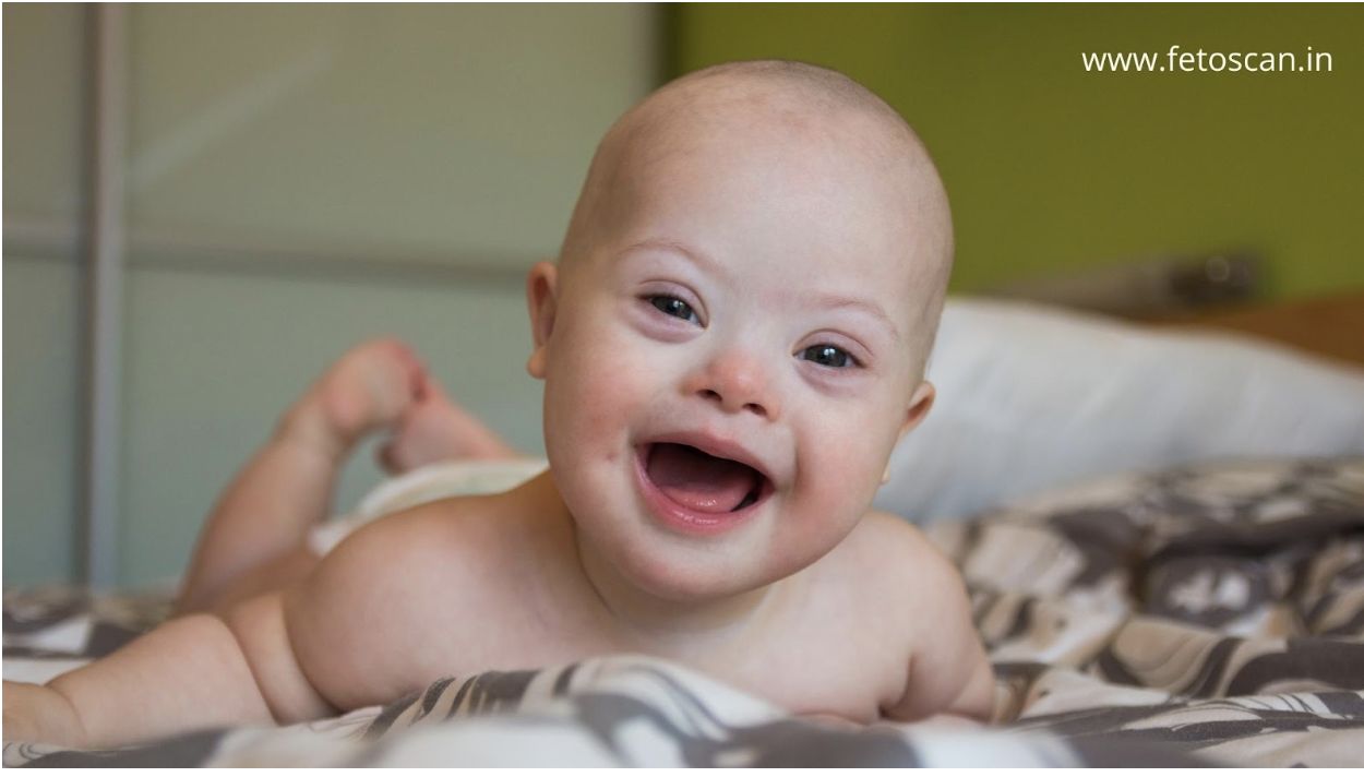 Read more about the article Detecting Down Syndrome before Birth: By a Fetal Care Expert